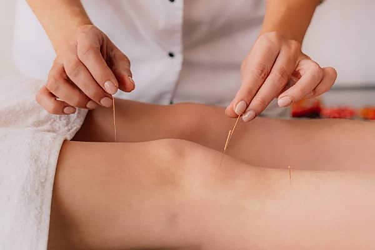 Best Acupuncture in Yaletown